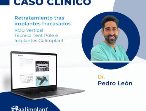 Retratamiento tras implantes fracasados con ROG Vertical