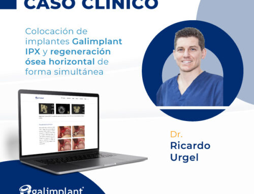 Colocación de implantes Galimplant IPX y regeneración ósea horizontal