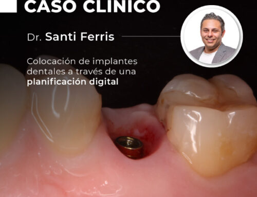 Colocación de implantes dentales a través de una planificación digital