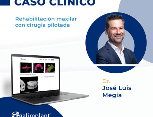Caso clínico | Rehabilitación Maxilar con Cirugía Pilotada