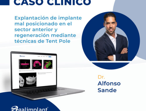 Caso clínico | Explantación de implante mal posicionado y regeneración técnica Tent Pole