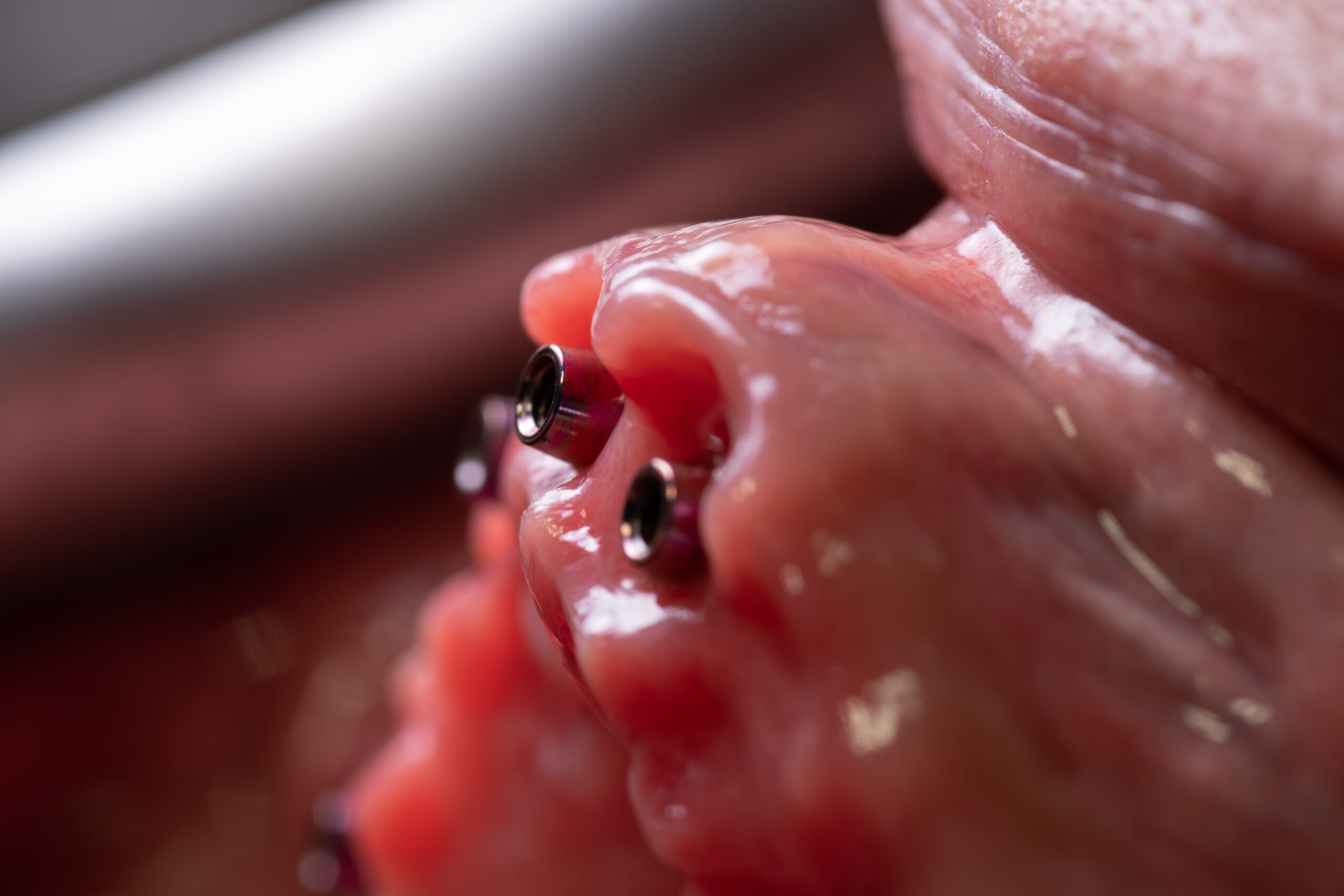 perfil-emergencia-galimplant